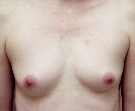 Breast Augmentation - Case 864 - Before