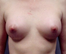 Breast Augmentation - Case 864 - After