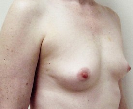 Breast Augmentation Patient Photo - Case 864 - before view-1