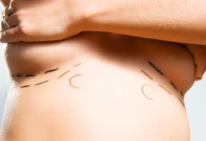 Breast Augmentation img 1