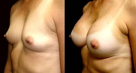 Breast Augmentation Patient Photo - Case 908 - before view-1