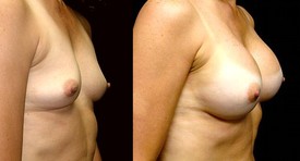 Breast Augmentation Patient Photo - Case 908 - after view-1