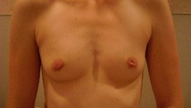 Breast Augmentation - Case 913 - Before