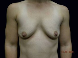 Breast Augmentation Patient Photo - Case 916 - before view-