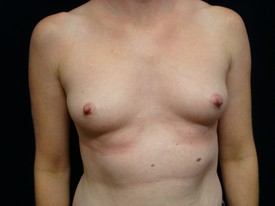 Breast Augmentation Patient Photo - Case 921 - before view-