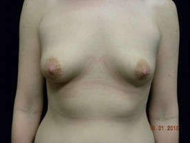 Breast Augmentation Patient Photo - Case 926 - before view-