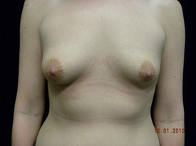 Breast Augmentation - Case 926 - Before