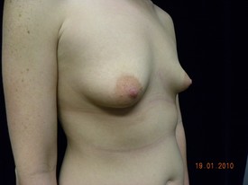 Breast Augmentation Patient Photo - Case 926 - before view-1