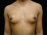 Breast Augmentation - Case 931 - Before