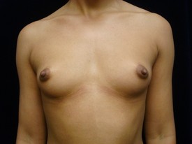 Breast Augmentation Patient Photo - Case 931 - before view-