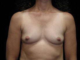 Breast Augmentation Patient Photo - Case 936 - before view-0