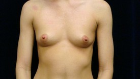 Breast Augmentation Patient Photo - Case 941 - before view-