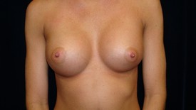 Breast Augmentation Patient Photo - Case 941 - after view