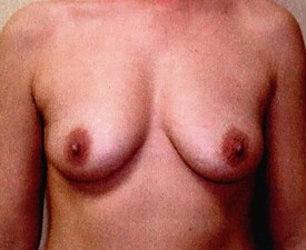 Breast Augmentation Patient Photo - Case 870 - before view-0