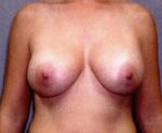 Breast Augmentation - Case 870 - After
