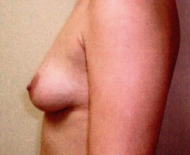 Breast Augmentation Patient Photo - Case 870 - before view-1