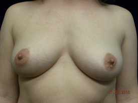 Breast Augmentation - Case 967 - Before