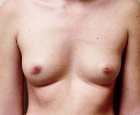 Breast Augmentation - Case 875 - Before