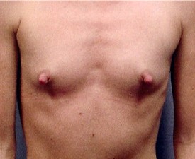 Breast Augmentation - Case 880 - Before