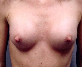 Breast Augmentation Patient Photo - Case 880 - after view
