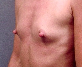 Breast Augmentation Patient Photo - Case 880 - before view-1