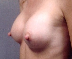 Breast Augmentation Patient Photo - Case 880 - after view-1
