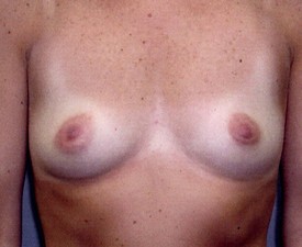Breast Augmentation Patient Photo - Case 885 - before view-0