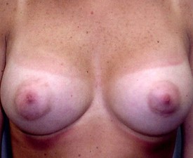 Breast Augmentation Patient Photo - Case 885 - after view