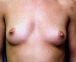 Breast Augmentation - Case 890 - Before