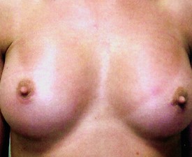 Breast Augmentation Patient Photo - Case 890 - after view