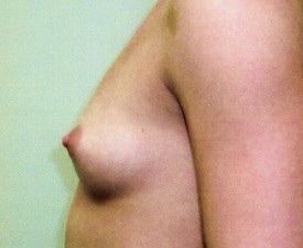 Breast Augmentation Patient Photo - Case 890 - before view-1