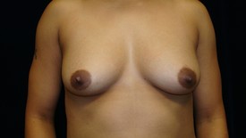 Breast Augmentation Patient Photo - Case 903 - before view-0