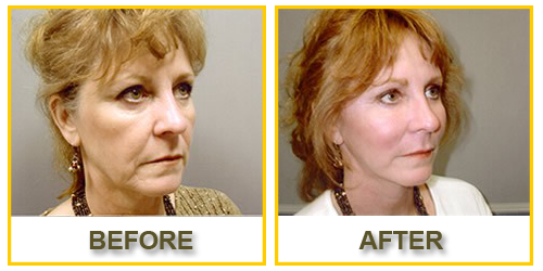 before and after