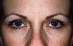 Botox Treatments - Case 991 - After