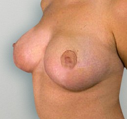 Breast Reduction - Case 1040 - After