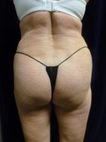 Buttock Lift - Case 1066 - After