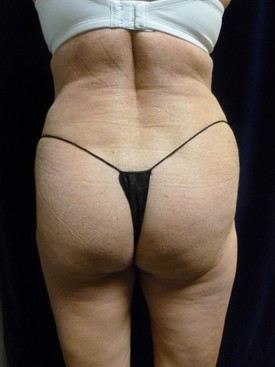 Buttock Lift Patient Photo - Case 1066 - after view