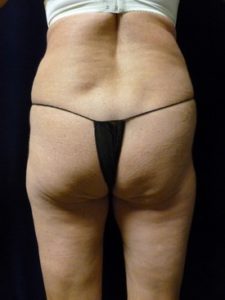 Buttock Lift - Case 1066 - Before