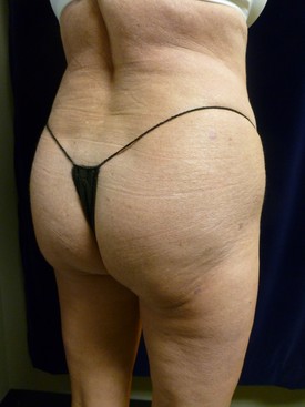 Buttock Lift Patient Photo - Case 1066 - after view-1