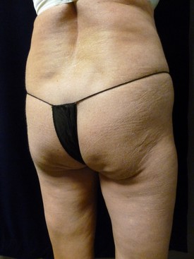 Buttock Lift Patient Photo - Case 1066 - before view-1