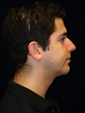 Chin & Cheek Implants Patient Photo - Case 1076 - after view-1