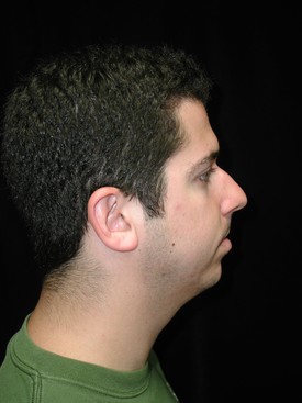 Chin & Cheek Implants Patient Photo - Case 1076 - before view-1