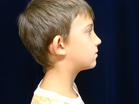 Ear Surgery Patient Photo - Case 1081 - before view-1