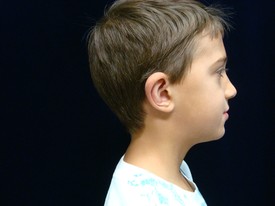 Ear Surgery Patient Photo - Case 1081 - after view-1