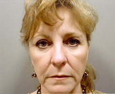 Facelift - Case 1106 - Before