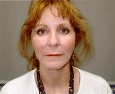 Facelift - Case 1106 - After