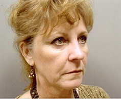 Facelift Patient Photo - Case 1106 - before view-1