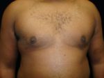 Male Breast Reduction - Case 1116 - After