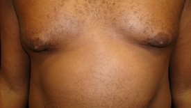 Male Breast Reduction Patient Photo - Case 1116 - before view-0