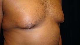 Male Breast Reduction Patient Photo - Case 1116 - before view-1